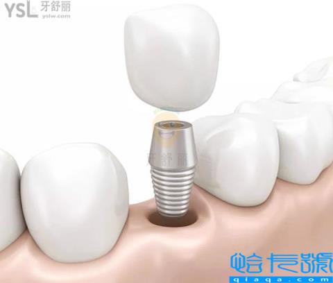 2022最新国产、进口种植牙价格表