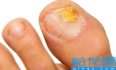 灰指甲最怕三个克星你知道吗(灰指甲不治疗的后果会致癌吗)