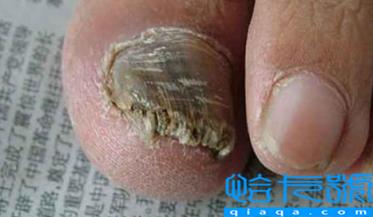 为什么只有大脚趾有灰指甲(重度灰指甲还能治愈吗)