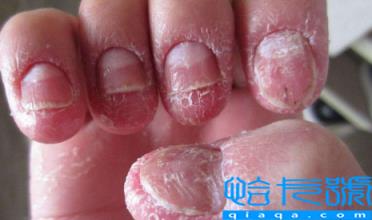 灰指甲如何把病甲修掉(灰指甲怎么软化脱落)
