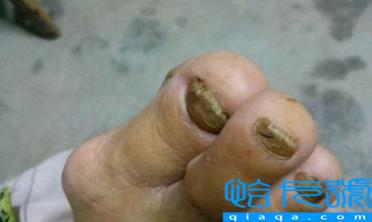 灰指甲最开始的症状会发脓吗(灰指甲6天自愈方法)